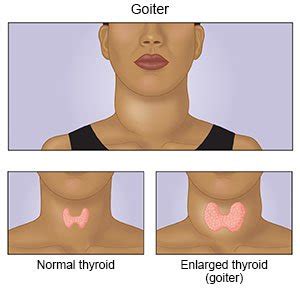 thyroid goiter