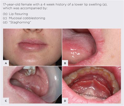 oral manifestations  inflammatory bowel disease medical forum