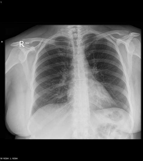 right middle lobe pneumonia buyxraysonline