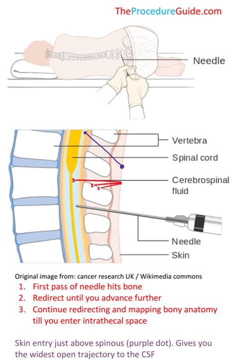 lumbar puncture spinal tap technique  overview  procedure guide