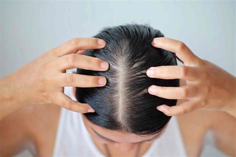 top    excessive hair loss female latest dedaotaonec