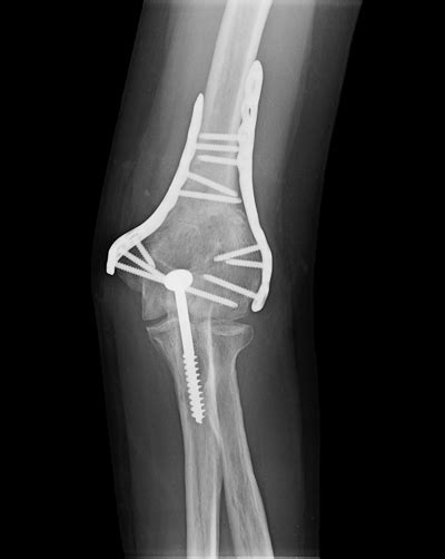 elbow fracture treatments dr skedros orthopaedics