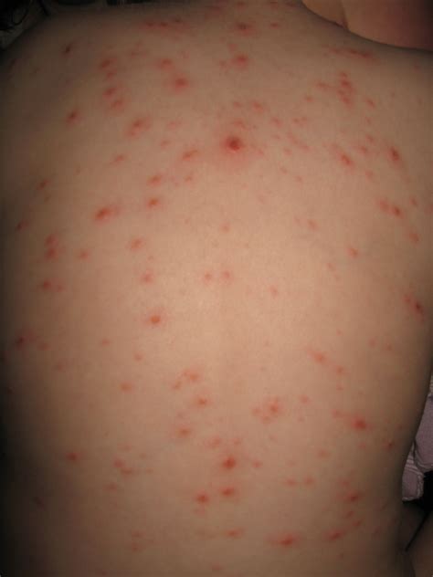 chickenpox rash causes symptoms treatment chickenpox rash