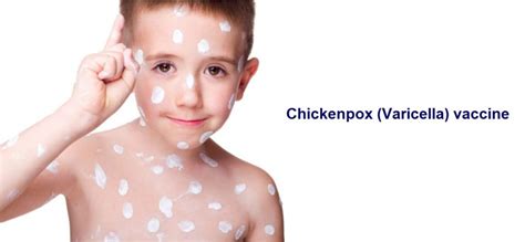 Chicken Pox Vaccine Uk Private Gp Clinic Regent Street Clinic™