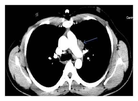 Axial Ct Scans Of The Chest A Mediastinal Window B Lung Window