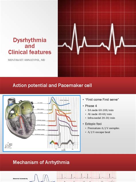 Dysrhythmia Cardiac Arrhythmia Cardiac Electrophysiology