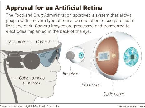 canadian medical history   received  bionic eye hope  focus