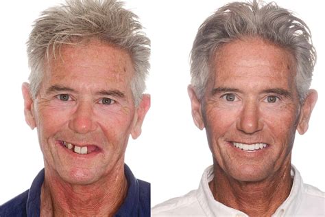 All On 4 Dental Implants How Do They Work And Are They For You