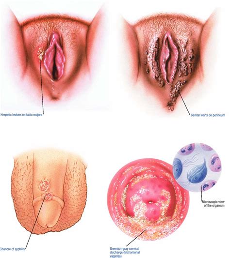 sexually transmitted infections atlas of pathophysiology