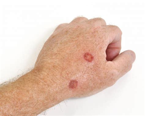common   skin lesions