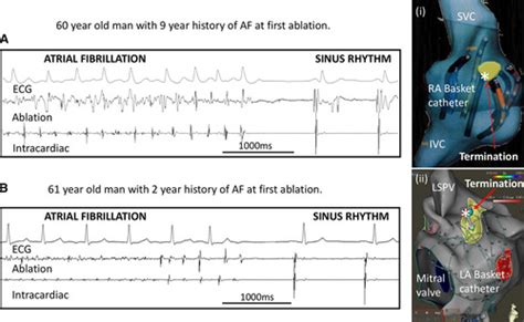 identification and characterization of sites where persistent atrial