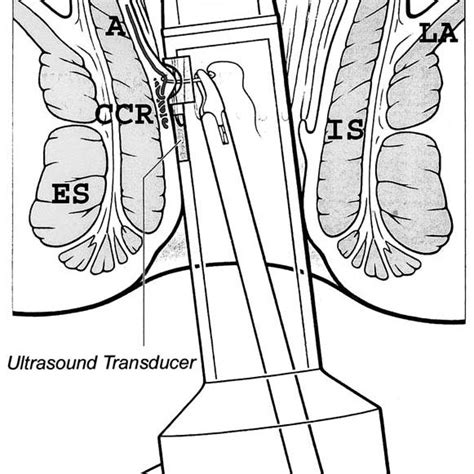 hemorrhoidal artery ligation hal  hal device  demonstrated  scientific diagram