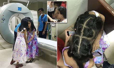 conjoined filipino twins to separate despite death risk