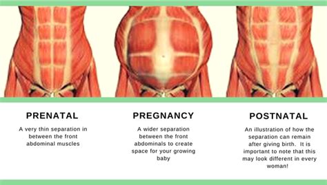 stomach muscles  pregnancy  day diastasis recti workout
