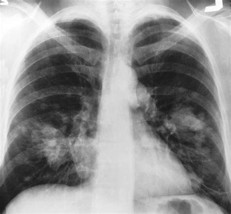 file x ray chest cancer