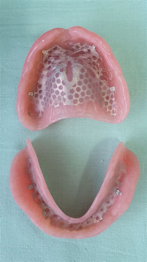 complete dentures