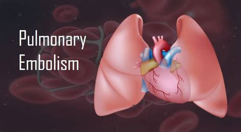 Pulmonary Thromboembolism Symptoms Causes And Treatment