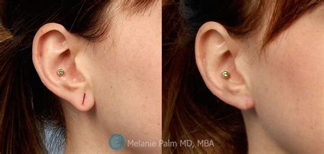 earlobe repair before and after photos dermatology san diego