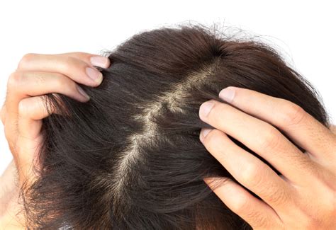 itchy scalp    fix  hair topper trends
