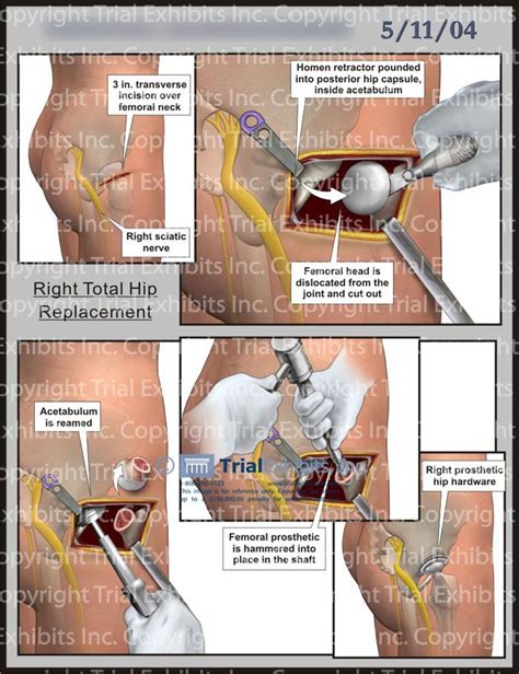15 Best Images About Hip Replacement Surgery On Pinterest Physical