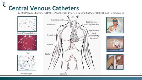 7 central venous catheters central venous catheters cvcs