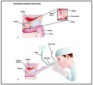 Sexual activity after turp