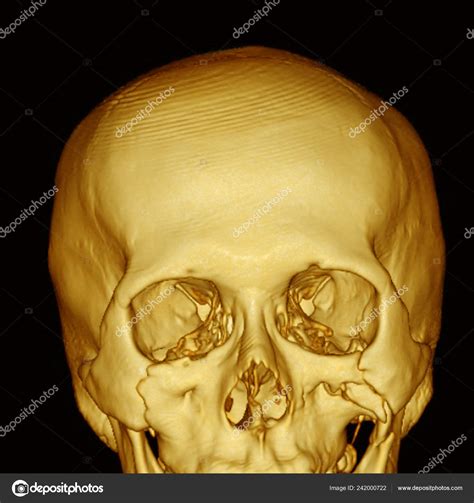 computed tomography 3dct scan facial bone showing multiple
