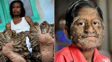 the 20 most shocking and bizarre diseases in the world therichest