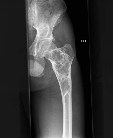 osteoarthritis   hip  fibrous dysplasia   proximal femur