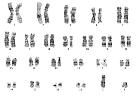 Karyotype Of Human Chromosomes Consisting Of 22 Autosomes Pairs And A