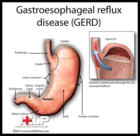 gastroesophageal reflux disease reflux disease gastroesophageal reflux disease