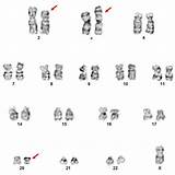 Abnormal Karyotype Chromosomes Representative sketch template