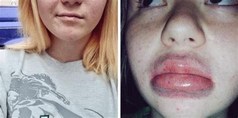 kylie jenner lips explode famous person