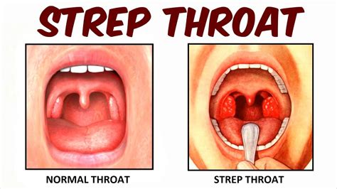 strep throat youtube