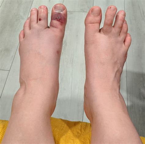 traditional chinese medicine case report broken big toe alina rehkopf