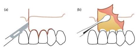 surgical endodontics pocket dentistry