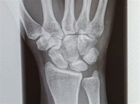 handgelenk angebrochen gesundheit medizin orthopaedie