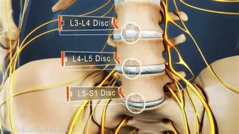 lumbar spine   disc   disc    disc lumbar disc bulging disc degenerative