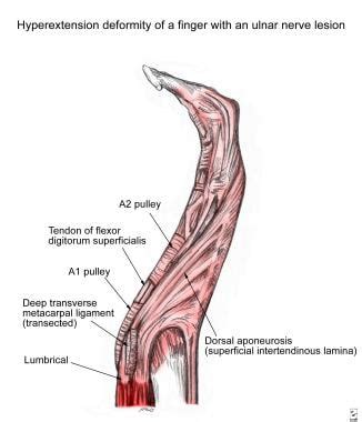 tendon transfers  upper extremity background concepts timing  tendon transfer