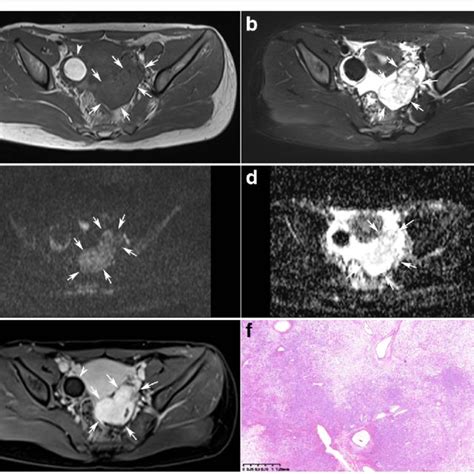 Magnetic Resonance Imaging Of A Large Ovarian Tumor