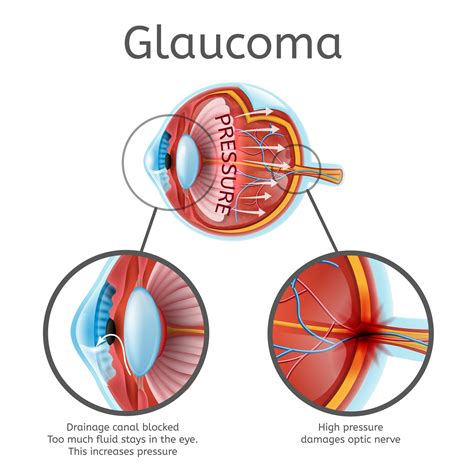glaucoma  myopia diagnostic dilemmas review  myopia management