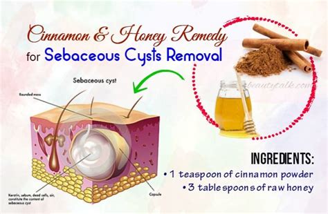 15 remedies on how to get rid of sebaceous cysts naturally cysts