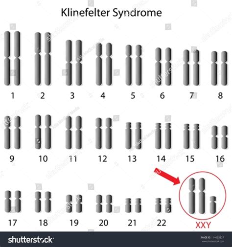 Klinefelter Syndrome Stock Vector 114653827 Shutterstock