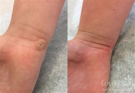 wart removal before and after photos
