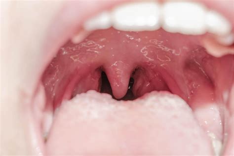 uvulitis     occur illnesses step  health