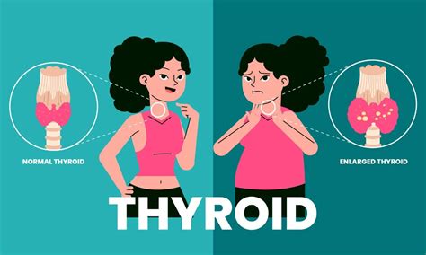 thyroid gland fitpaa