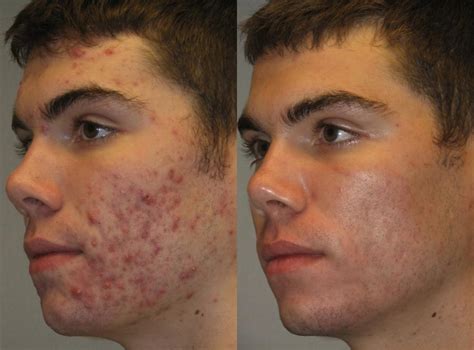 acne treatment transformation