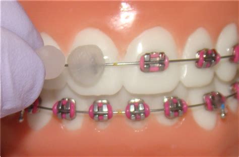 pin en orthodontics