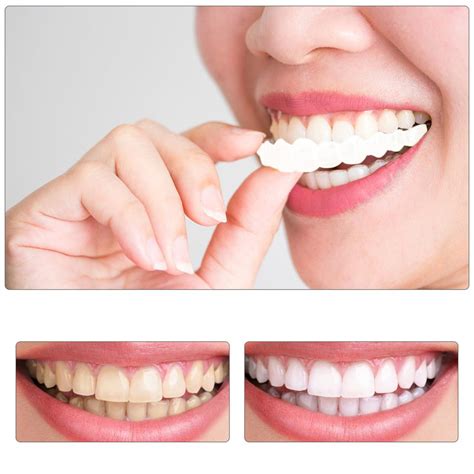 smile ashesive temporary smile comfort fit cosmetic teeth denture glue