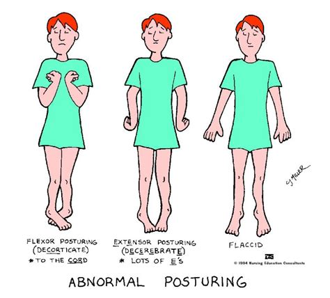 abnormal posturing critical care nursing neurology nursing